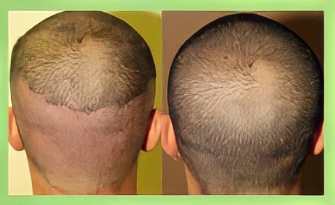 Anagen Hair Restoration | Washington DC, Maryland, Virginia | (301) 591-6552