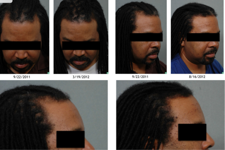 before and after hair transplant images