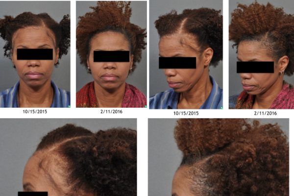 female hair restoration before and after