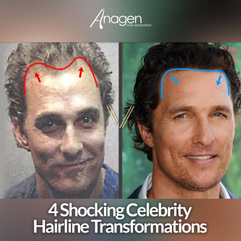 4 Shocking Celebrity Hairline Transformations